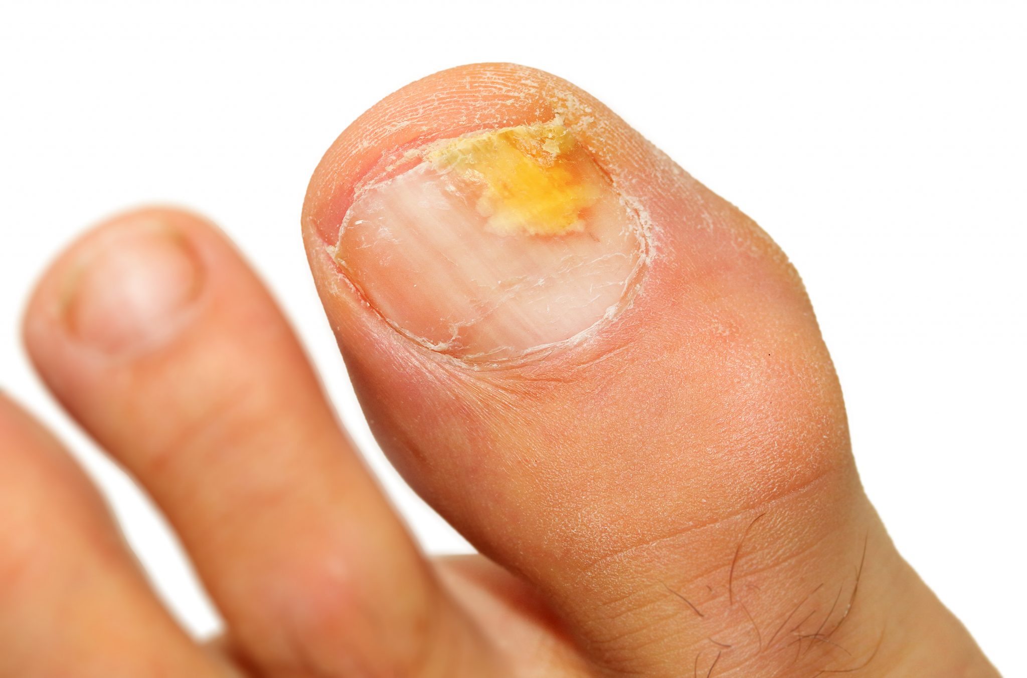 8. Foot Nail Color Changes and Fungal Infections - wide 8